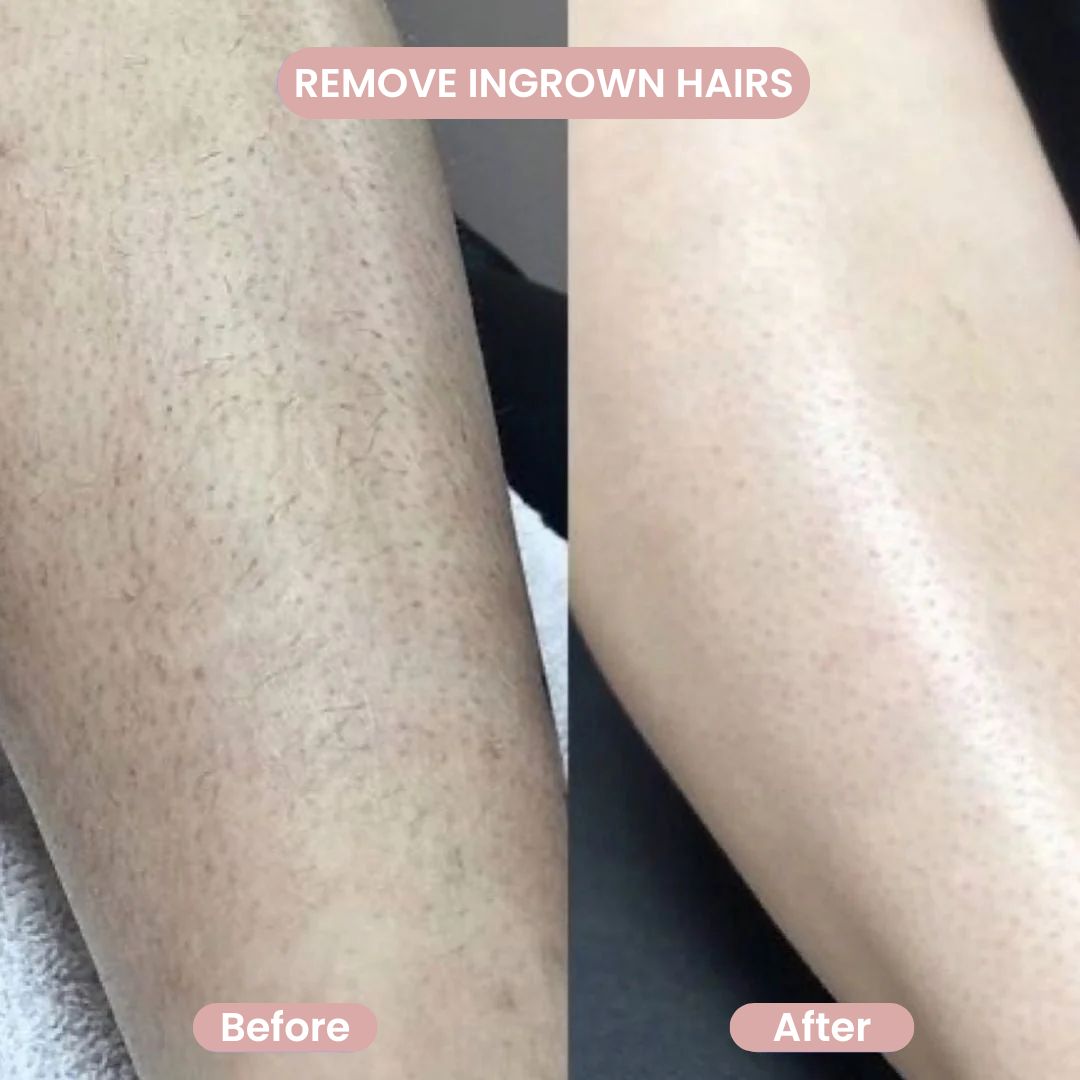 Before and after leg comparison showing the GlowShave women's body shaver removing ingrown hairs for smooth skin.