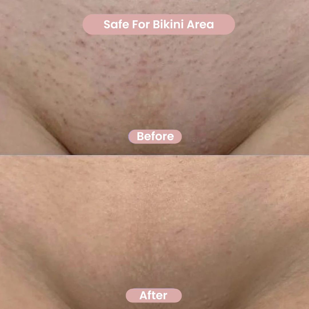Before and after results showing smooth skin on the bikini area using GlowShave women's body shaver and electric razor.
